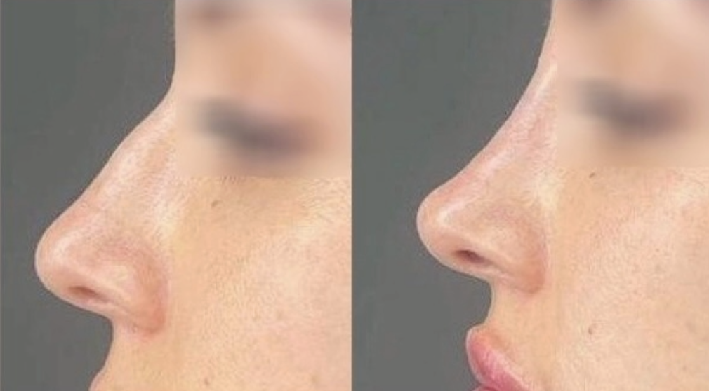 Sculptiva SHAPE Lido 1mL x 1 syr - Image 3