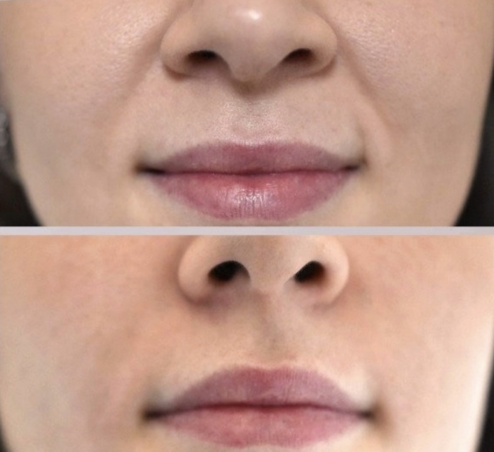 Sculptiva DEEP Lido 1mL x 1syr - Image 4