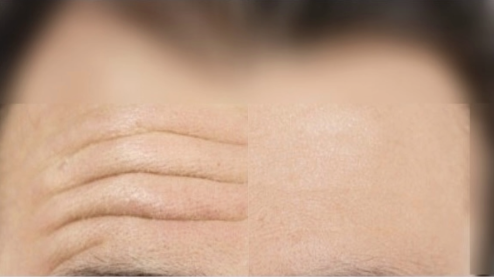 Sculptiva DEEP Lido 1mL x 1syr - Image 3