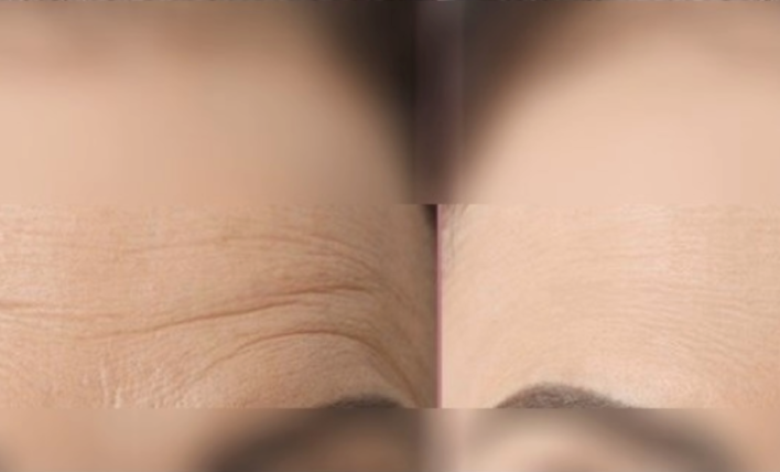 Sculptiva FINE Lido 1ml x 1 syr - Image 2