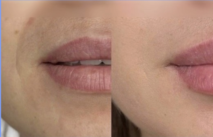 Sculptiva FINE Lido 1ml x 1 syr - Image 4